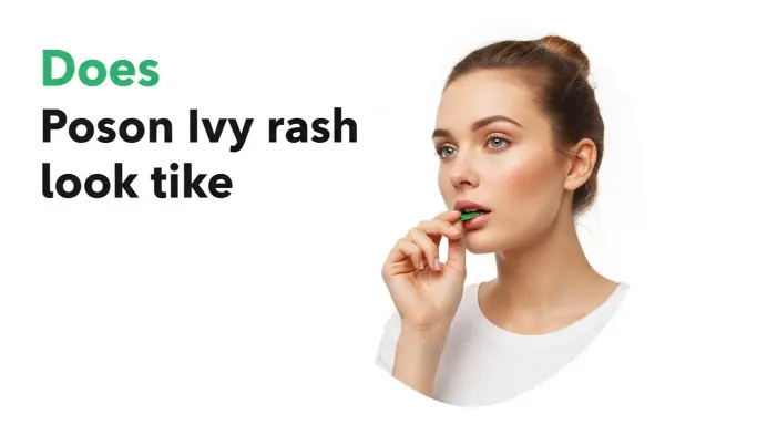 Does Poison Ivy Rash Look Like